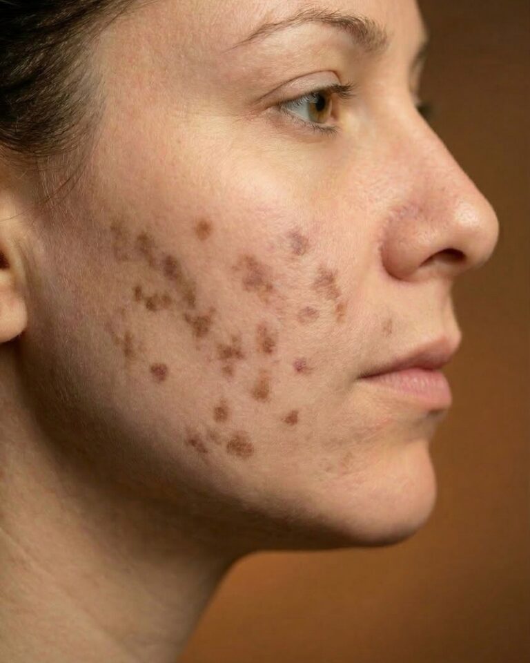 hiperpigmentacoes-pos-acne